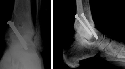 X rays of the ankle after successful fusion
