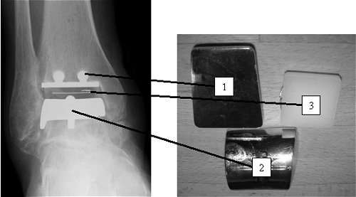 An X-ray and picture of a total ankle replacement: The ankle consists of two metal caps - one for the tibia (1), and one for the talus (2). The articulation occurs between the metal, and the plastic bearing (3).