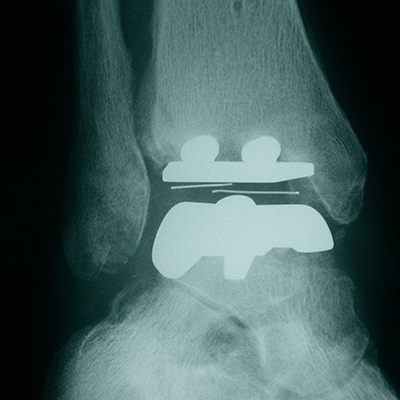 STAR ankle replacement