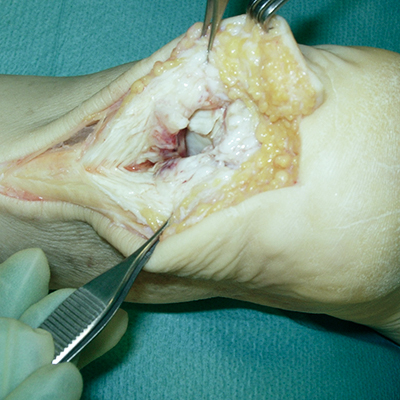 Achilles tendon