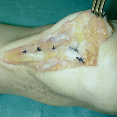 Achilles tendon