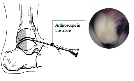 Arthroscope in the ankle