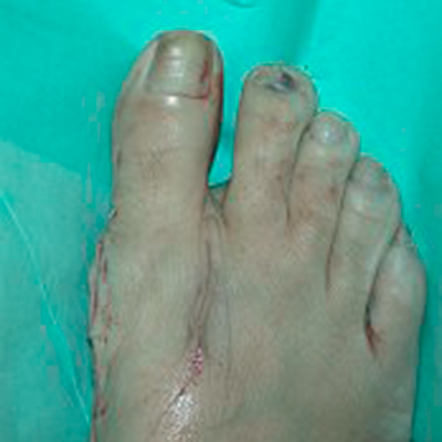 After bunion surgery
