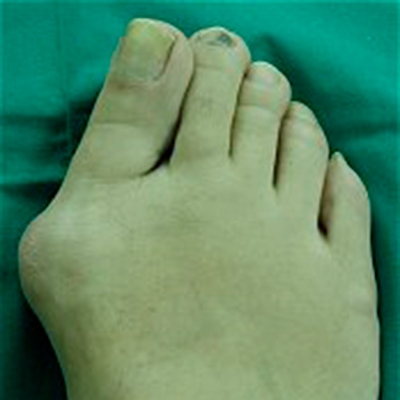 Bunion before surgery