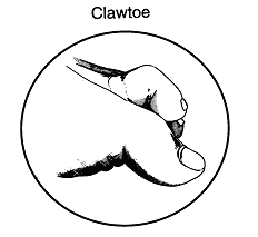 Claw toe