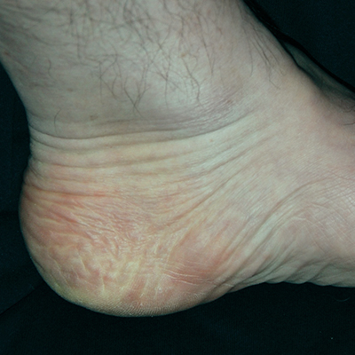 Heel pain