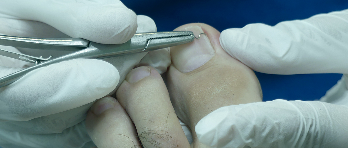Ingrowing toenail treatment
