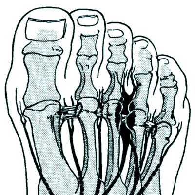 Morton’s neuroma diagram