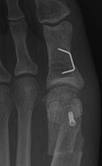 Metatarsal osteotomy
