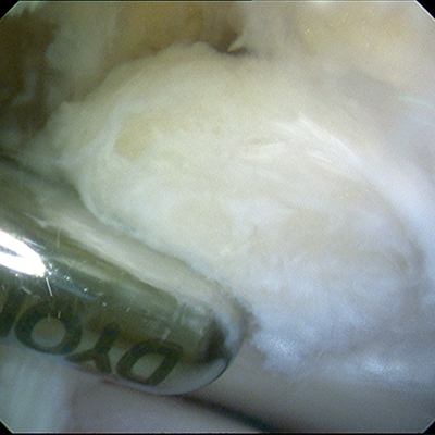 Posterior ankle scope